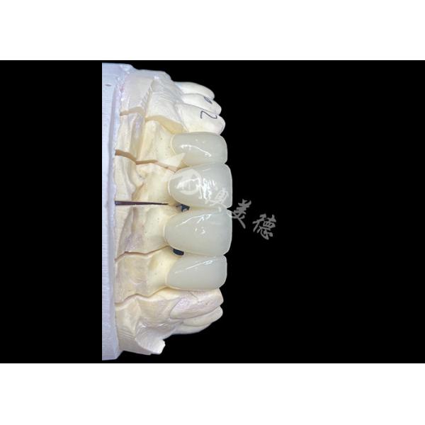 Natural-Looking Zirconia Ceramic Crown Bridge Provides Precision And Aesthetics