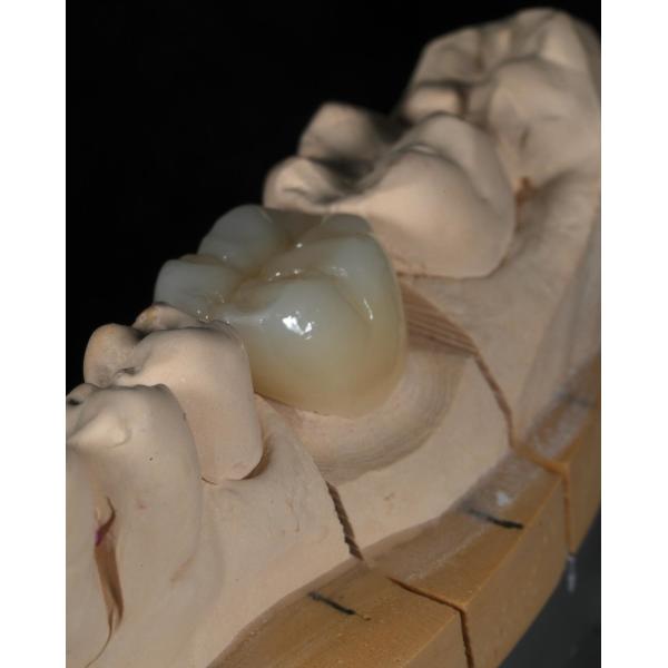 Full Contour Zirconia Crown Quick Turnaround for Precise and Aesthetic Fit in 1 Week
