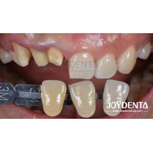 Painless Procedure BOPT Dental Technique for Accurate Tooth Preparation