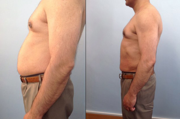 Buy cheap Focused ultrasound Body shape ultrashape hifu fat reduction machine for body slimming from wholesalers