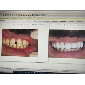 Buy cheap Yucera Multilayer Sht Zirconia Dental Block Amann System 89MM /Zirconia Disk for CAD CAM from wholesalers