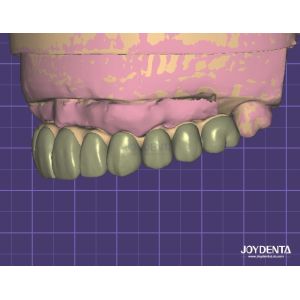 HIPAA Compliant Data Security Digital Wax Up 3D Model For Dental Modifications