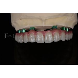 Buy cheap Zirconia All-on-4 Implant Procedure Same Day Recovery Minimal Follow Up Needed from wholesalers