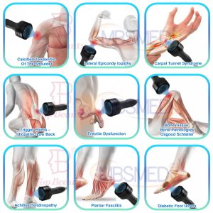 Buy cheap Difference between Focused and Radial Shockwave Therapy Machine Maximum Intensity Concentrated Superficially from wholesalers