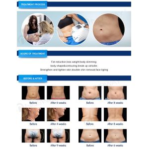 Buy cheap Nubway 5 handles cryolipolysis fat freeze slimming machine  FDA CE approved  80%  salon clinic used from wholesalers