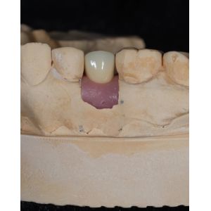 Screw Cement Retained Implant For Long-Lasting Dental Implants With 5-Year