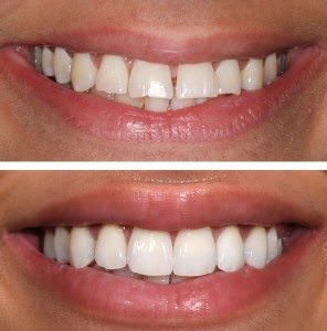 Yucera 5-Axis Dental Cad Cam Milling Machine Wet for Lithium Disilicate Cad Cam