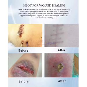 Buy cheap Hyperbaric Oxygen Chamber 1.3ATAT 1.5ATAT 2.0 ATAT from wholesalers