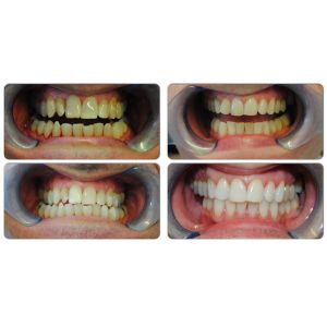 Professional LED light teeth whitening machine with mouth gag for sale