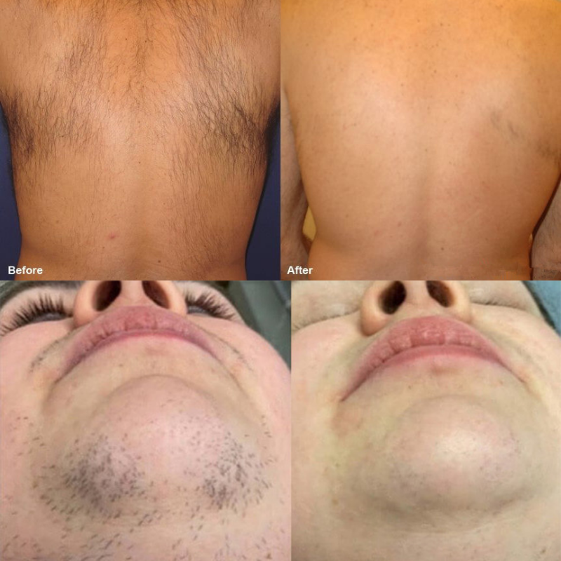 Buy cheap 2 in 1 808nm Diode Laser Device with Scalp and Skin Analysis Function TEC Sapphire Cooling Diode Laser Hair Removal Equipment from wholesalers