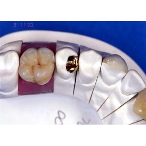 Buy cheap PFM Porcelain Dental Crown from wholesalers