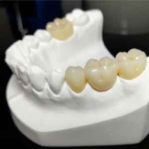 Unwavering Quality The Mark Of Our Ceramic Dental Crowns