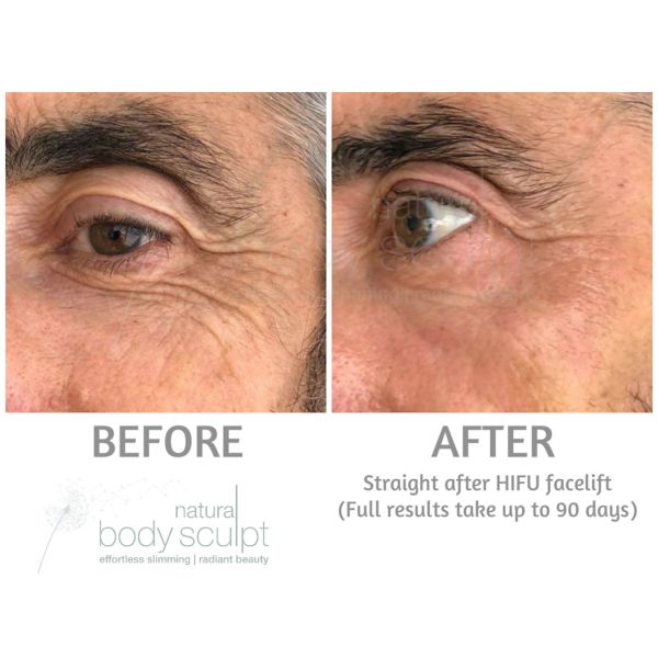 Manufacturer Portable HIfu 7D Machine With 9 cartridges /mmfu Face Lift Beauty Equipment