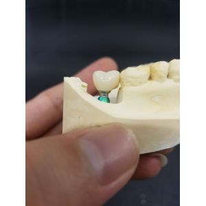 Buy cheap Smooth Surface Biocompatible Zirconia Tooth Crown Easy Maintain from wholesalers