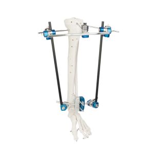 Gather Hoffmann 2 External Fixation Rods For Pelvic Fractures