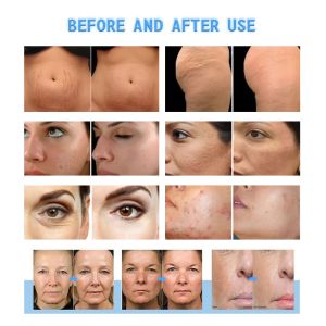 Buy cheap Professional RF Microneedling Machine With RF Radiofrecuent CE approved from wholesalers