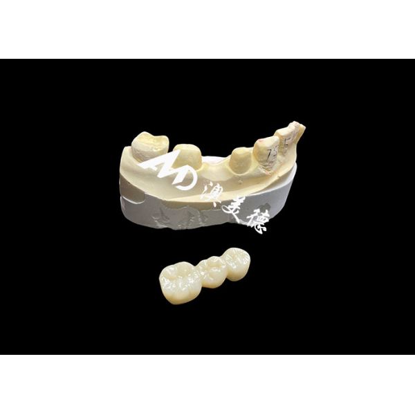 High-Hardness Aesthetic Zirconia Dental Crown with Translucency and Chipping