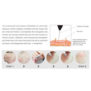 Buy cheap 2019 Lastest High quality with Immedictely Spider laser vein removal machine for sale from wholesalers