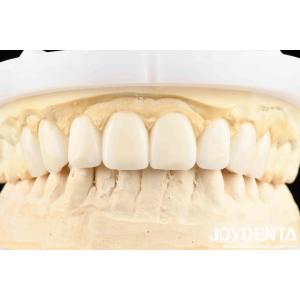 Dental's Good Elasticity And Tooth Arrangement Technology Flexible Denture